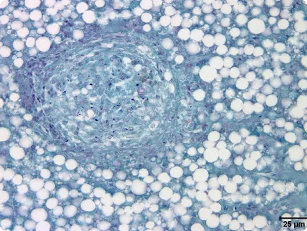 Mycobacterial Lesion in Fish Liver (Acid-Fast Stain)
