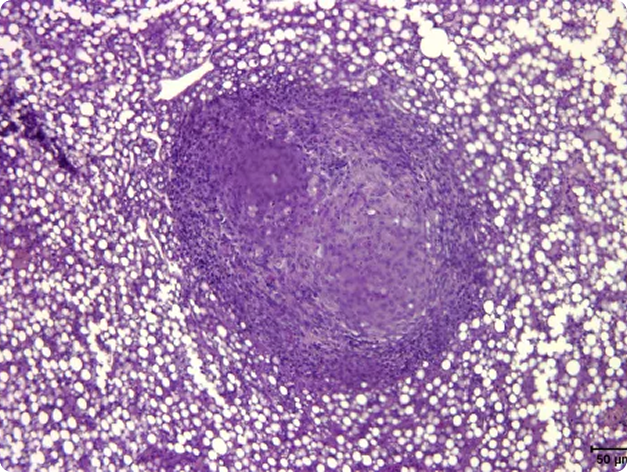 Mycobacterial Lesion in Fish Liver