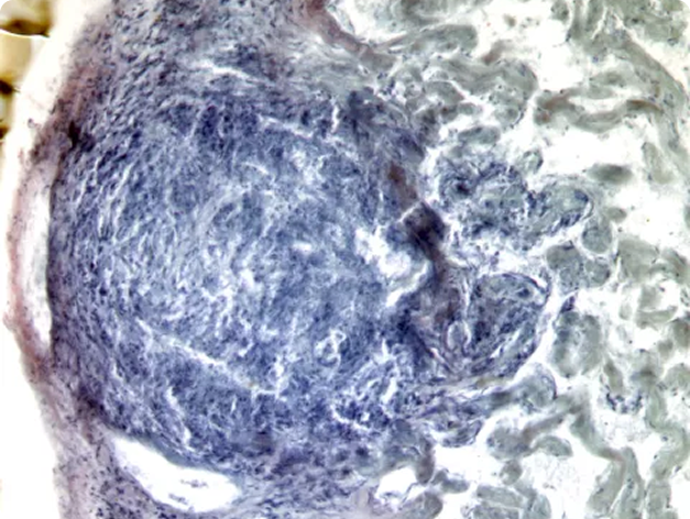 Mycobacterial Lesion in Sculpin