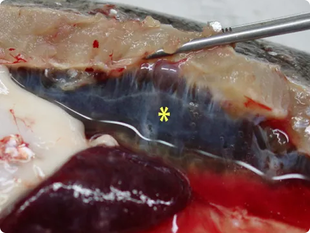 Swollen Kidney (Starred) Due to PKD
